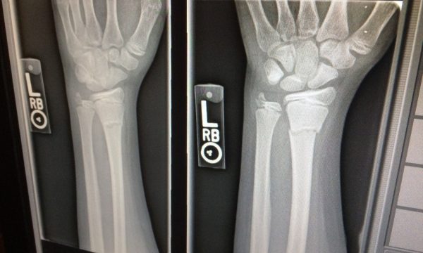 osteoporoza vzroki, simptomi in zdravljenje